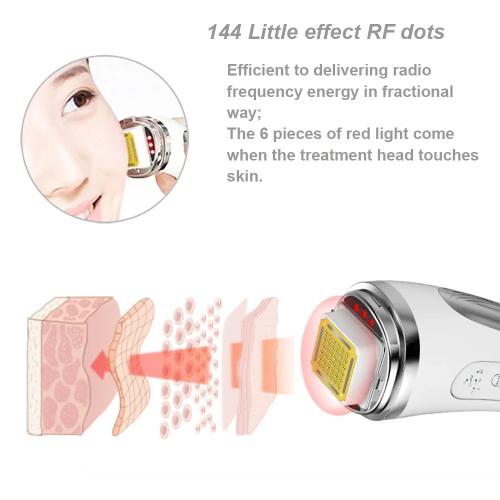 RF Facial Lifting & Wrinkle Removal